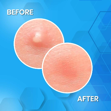 Hydrocolloid Acne Patch